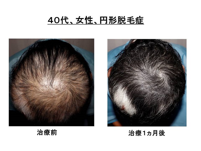 円形脱毛症　病院